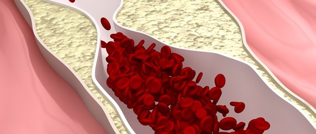 remedios arteriosclerosis