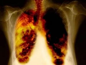 remedios para el cámcer pulmonar