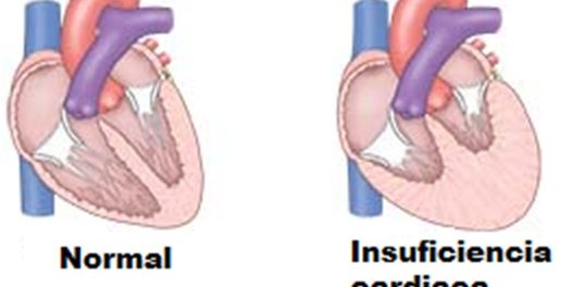 insuficiencia cardiaco