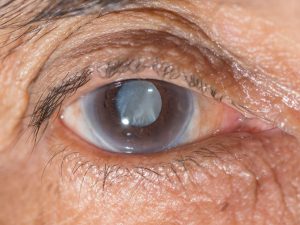 remedios caseros para el glaucoma