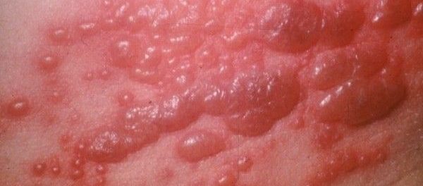 herpes genital