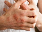 emedios para el dermatitis de contacto