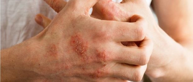 emedios para el dermatitis de contacto