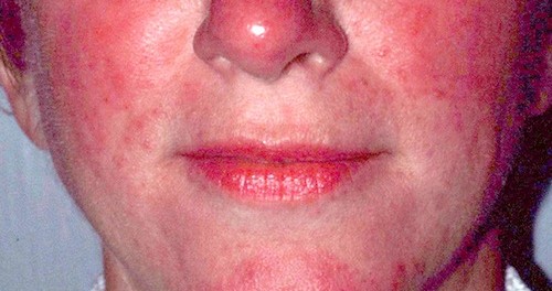 remedios para la rosacea