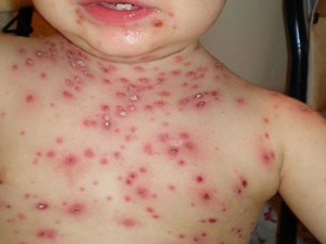 remedios para la varicela