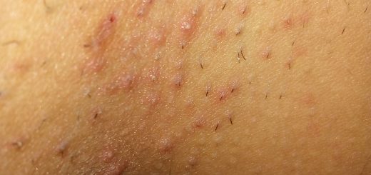 remedios para la foliculitis