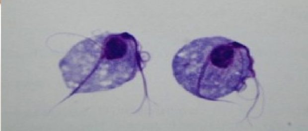 Remedios caseros para la tricomoniasis