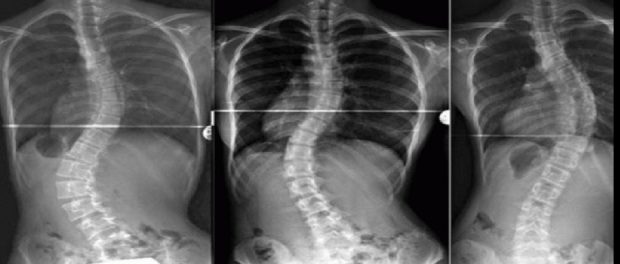 remedios para la escoliosis
