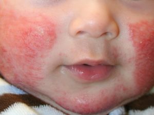 Remedios para dermatitis atópica en bebés y niños