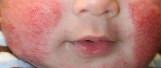 Remedios para dermatitis atópica en bebés y niños