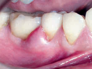remedios para el absceso dental