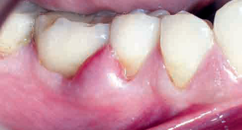 remedios para el absceso dental