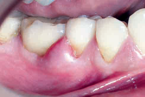 remedios para el absceso dental