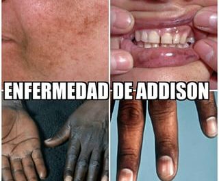 remedios enfermedad de addison