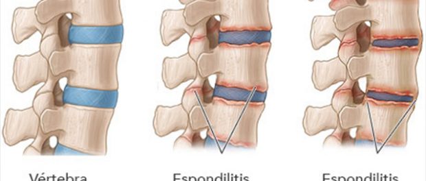 remedios espondilitis