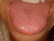 remedios para la lengua inflamada