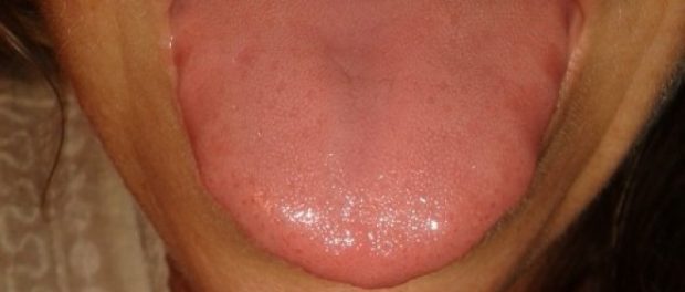 remedios para la lengua inflamada