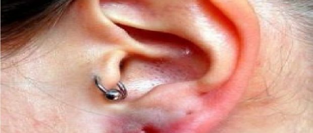 oreja infectada por arete