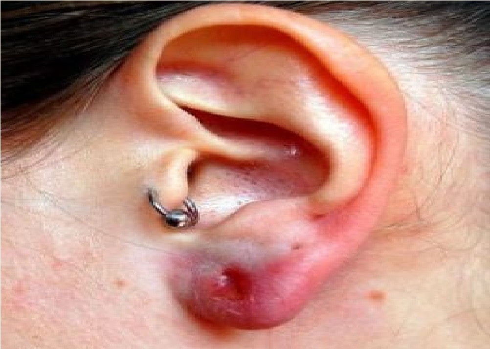 Oreja infectada por arete y pomada para infección en el lóbulo de la oreja.