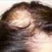 Remedios para calvicie en la mujer o alopecia femenina