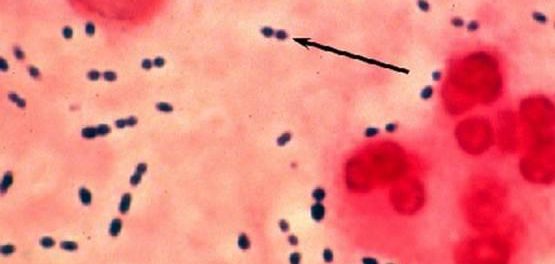 Enterococcus faecalis tratamiento natural