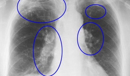 remedos fibrosis-pulmonar