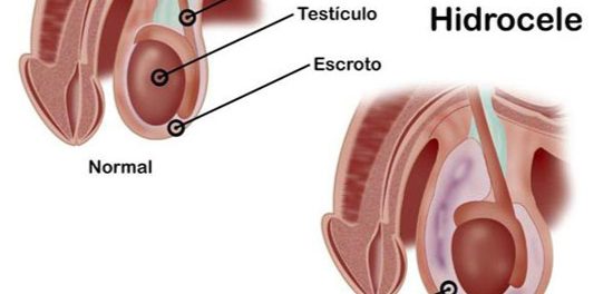 remedios hidrocele