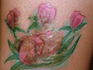 remedios tatuaje infectado