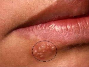 Suplementos para herpes labial