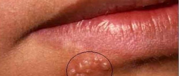 Suplementos para herpes labial