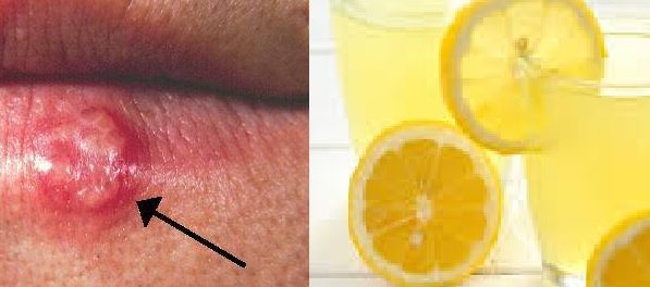 vitaminas y minerales para el herpes labial
