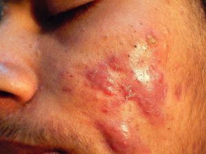 remedios acné quístico