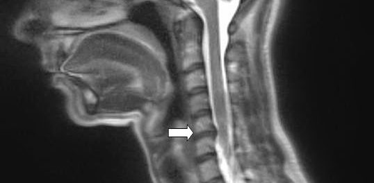 remedios espondilosis cervical