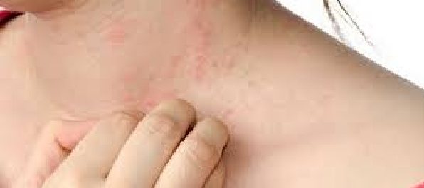 remedios para urticaria