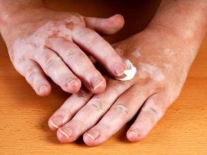 dr gracian rondon vitiligo