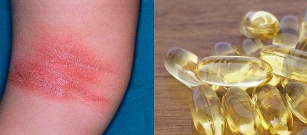 vitaminas y minerales para la dermatitis