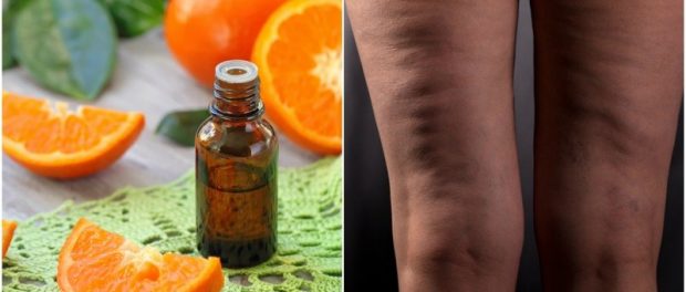 aceites esenciales para la celulitis