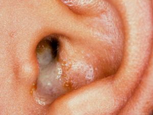 Remedios para secreción en el oido o otorrea