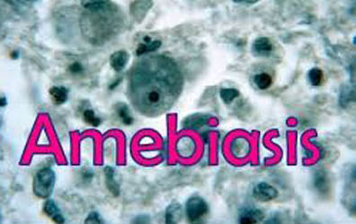 amebiasis