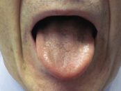 remedios síndrome de boca ardiente