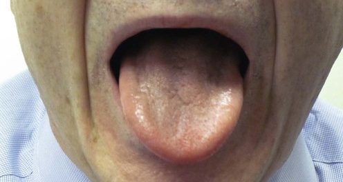 remedios síndrome de boca ardiente