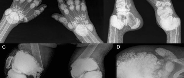 hipervitaminosis B