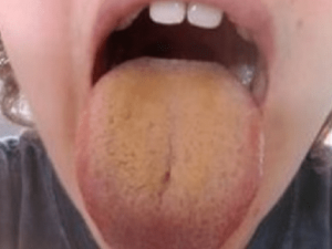 Remedio casero para limpiar la lengua amarilla 