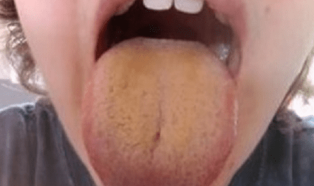 Remedio casero para limpiar la lengua amarilla 