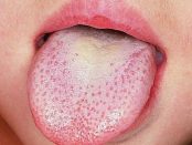 Remedios caseros para los puntos rojos en la lengua