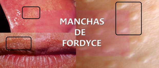 manchas