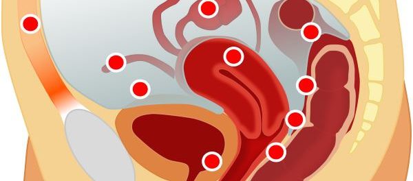 remedios para la adenomiosis