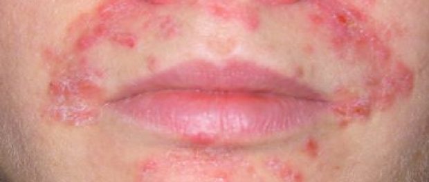 Dermatitis perioral tratamiento natural